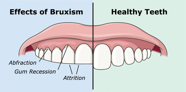 Teeth Grinding or Bruxism Can be Dangerous for You