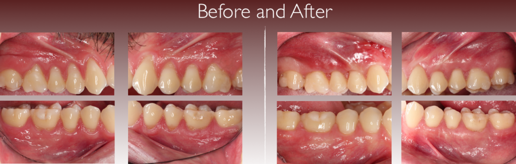 gum-grafting-clear-dental