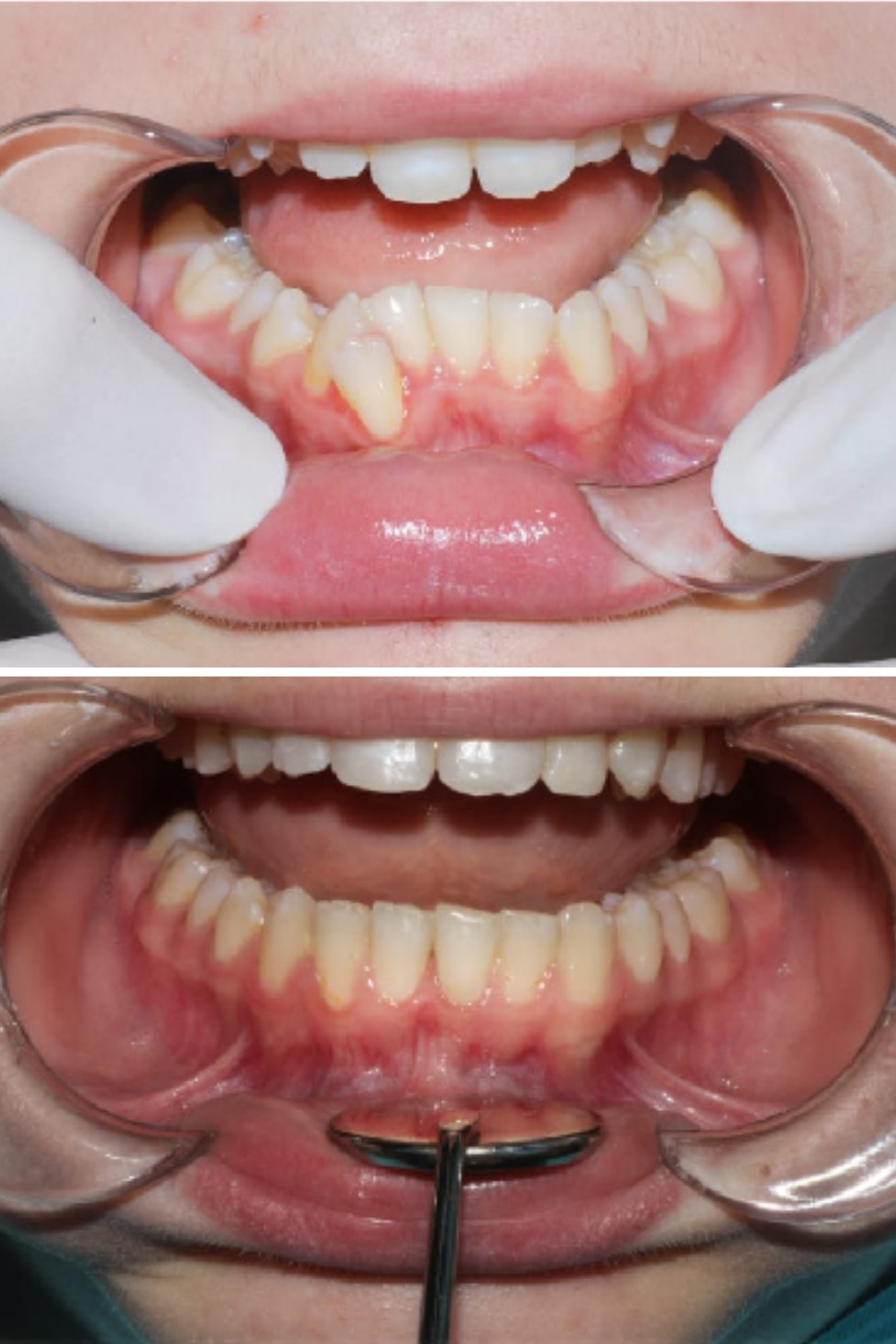 Before and After Braces Photos Invisalign Clear Aligners for Crooked Teeth