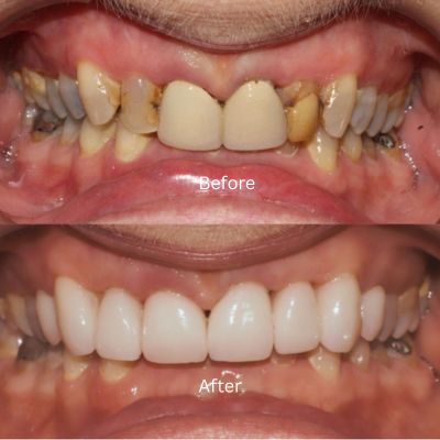Crown veneer transformation by Dr Phillip Mak