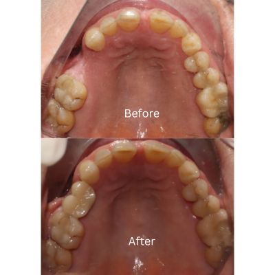 Implant transformation by Dr Phillip Mak