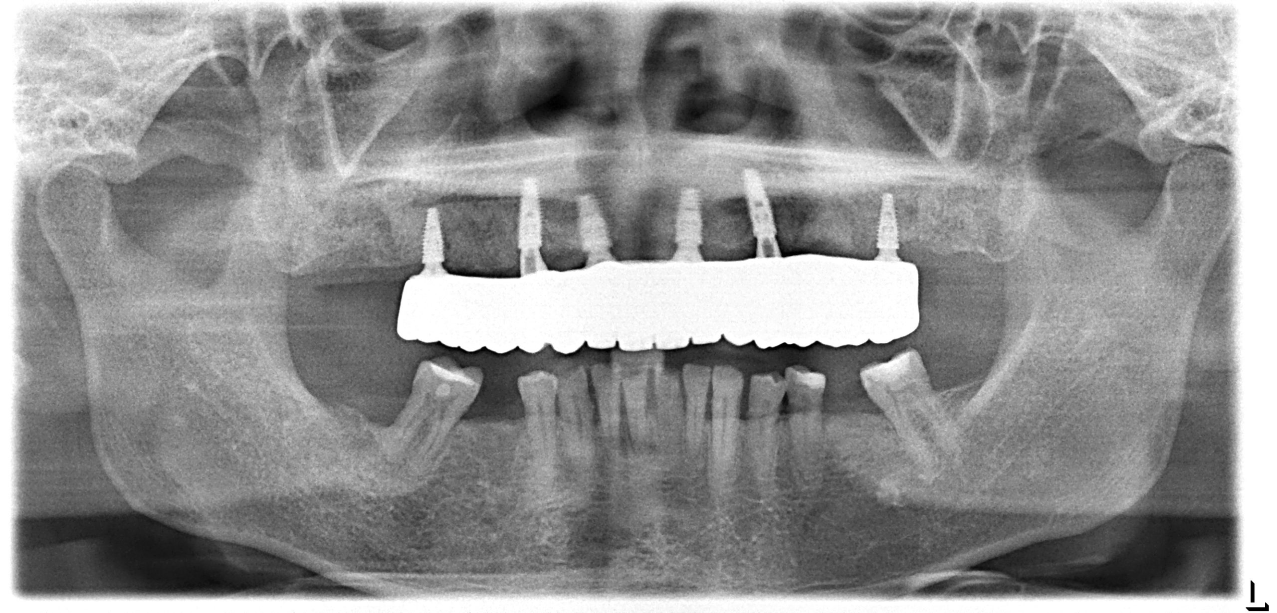 Panoramic X-ray showing six dental implants supporting a full-arch fixed bridge