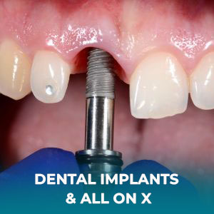 All-on-4 or All-on-X treatment