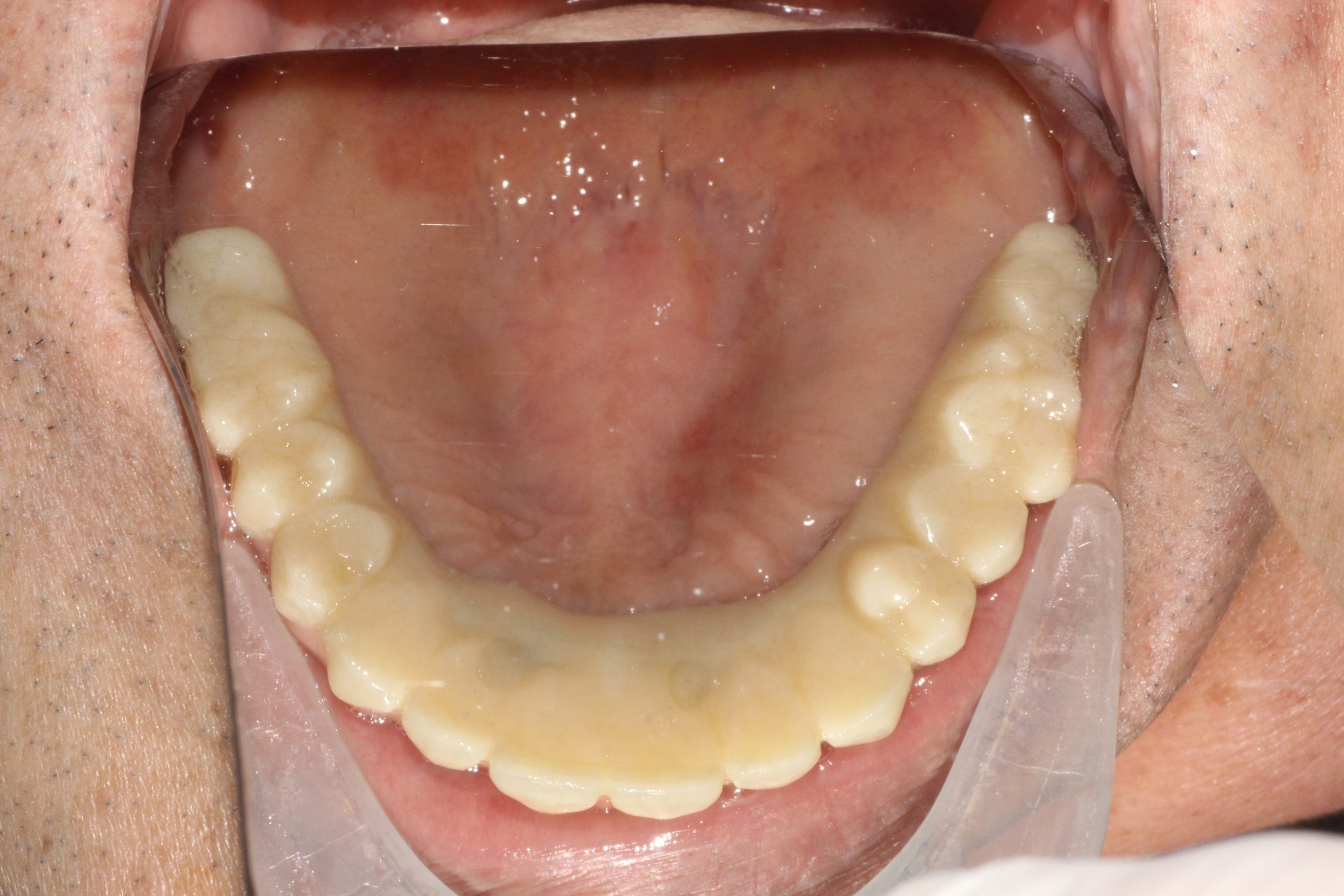 Occlusal view of the final upper implant bridge