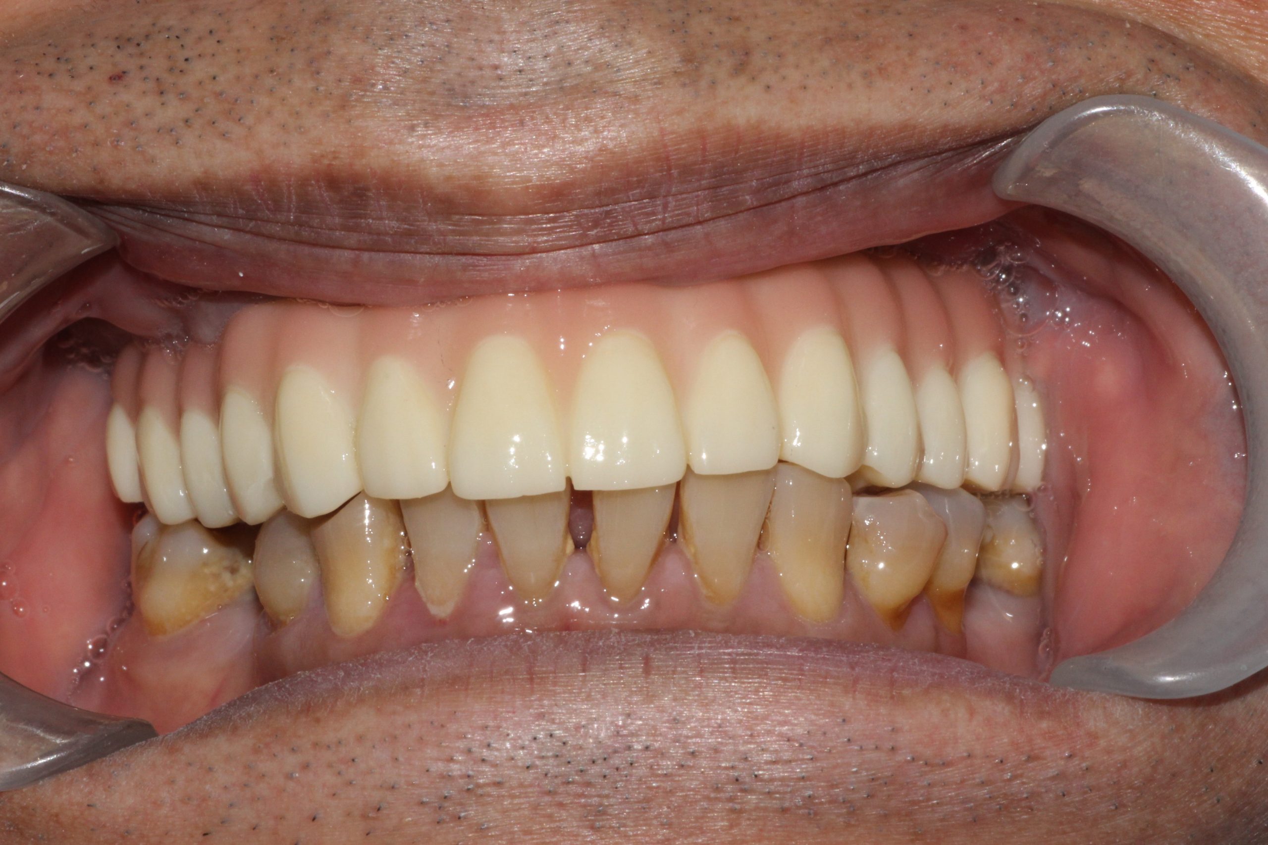Intraoral front view of the provisional upper bridge fitted during treatment