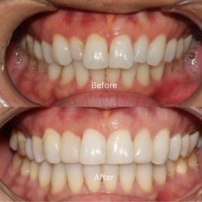 Invisalign, bonding, and whitening transformation by Dr Phillip Mak
