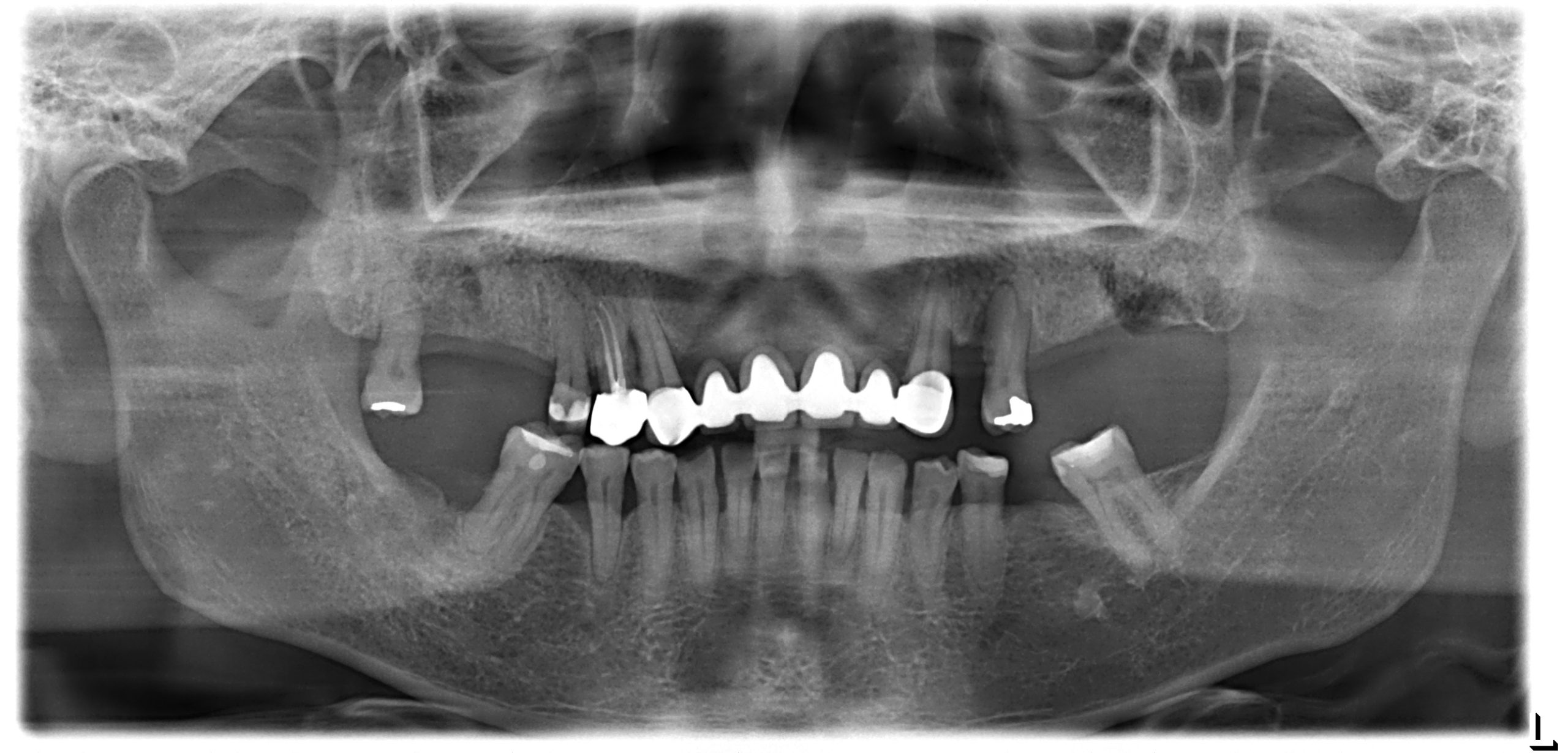 Pre-treatment panoramic X-ray showing extensive tooth decay and failing upper teeth before treatment