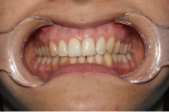 Invisalign