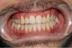 Invisalign