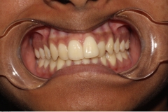 Invisalign