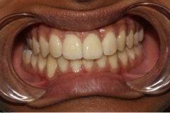 Invisalign