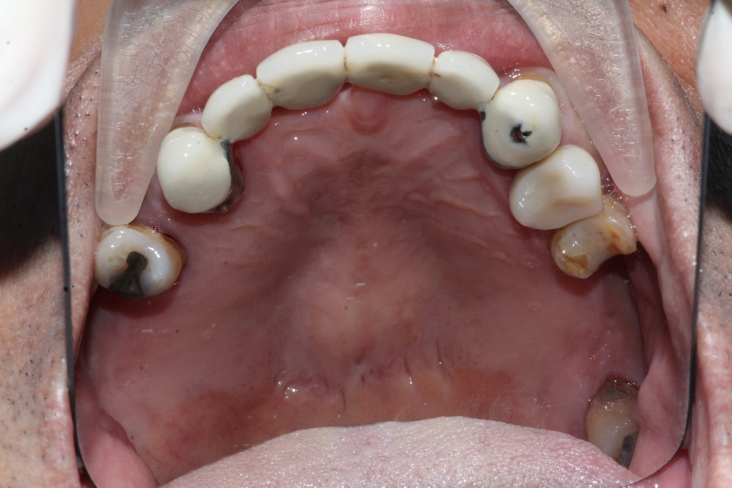 Occlusal view of the upper jaw showing decayed and heavily restored teeth before treatment
