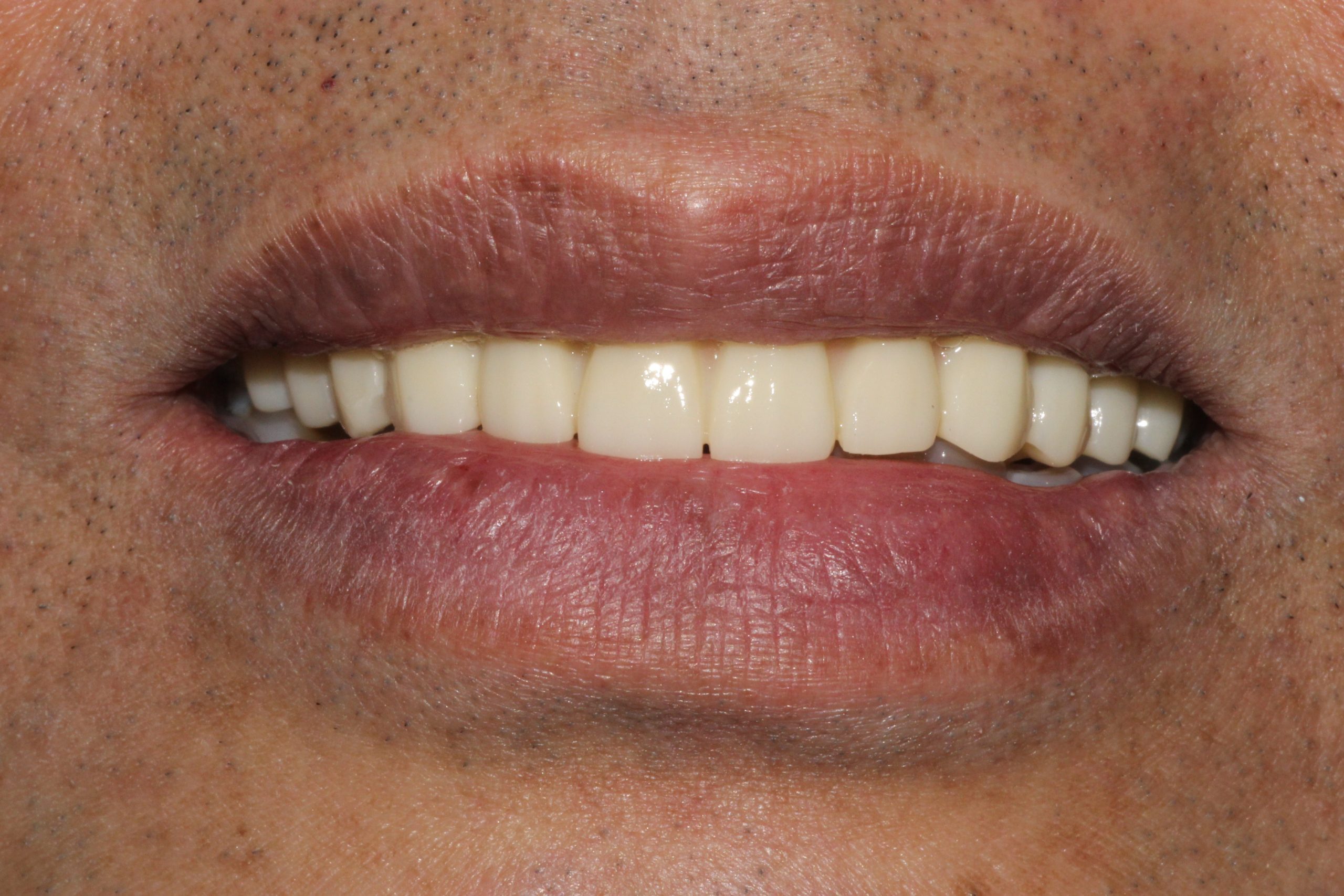 Alternate intraoral view of the completed full-arch implant bridge