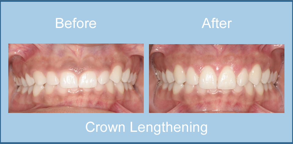 Gum Contouring in Singapore  Perfect Ratio of Gum to Teeth