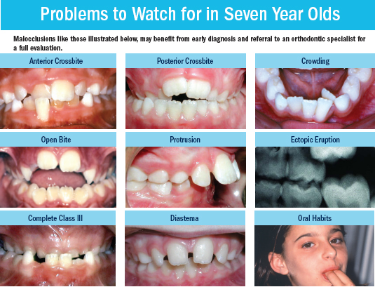Child orthodontic issues