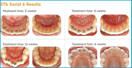 Orthodontics Australia  Your Guide to Lingual Braces [Including