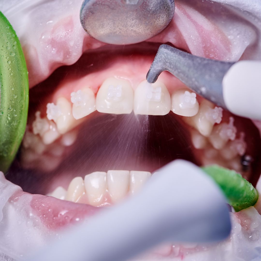 5 Reasons You Need To See A Dental Hygienist