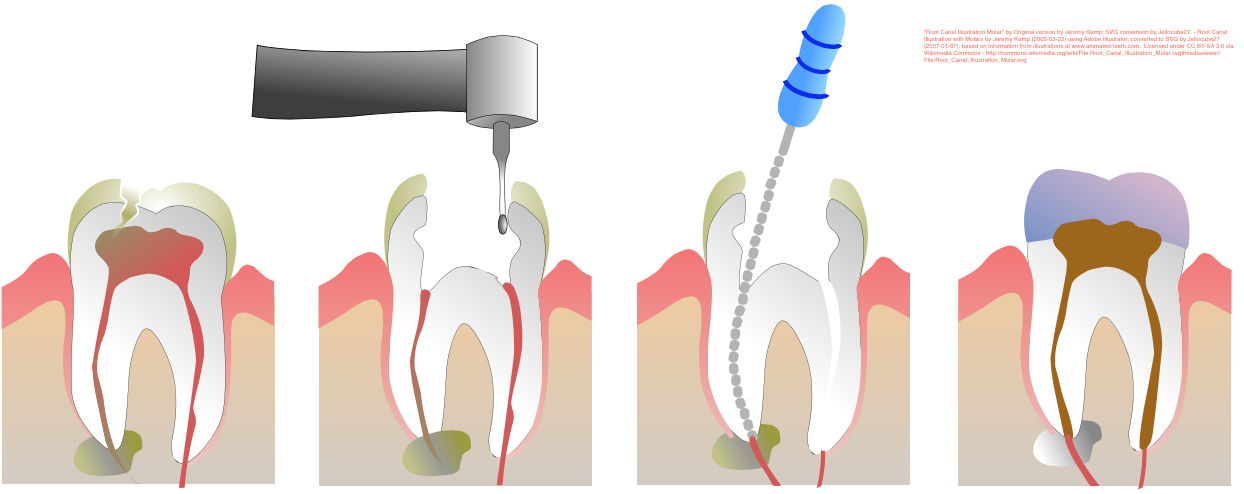 Why Might You Need A Root Canal?