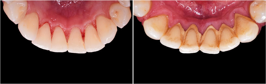 HOW TO PREVENT GUM DISEASE