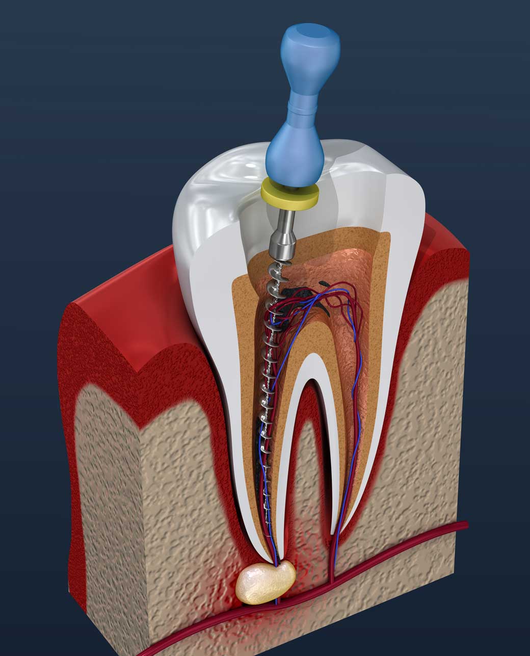 Understanding Root Canal Treatment: What You Need to Know