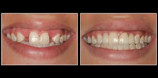 What Is Fixed Partial Denture