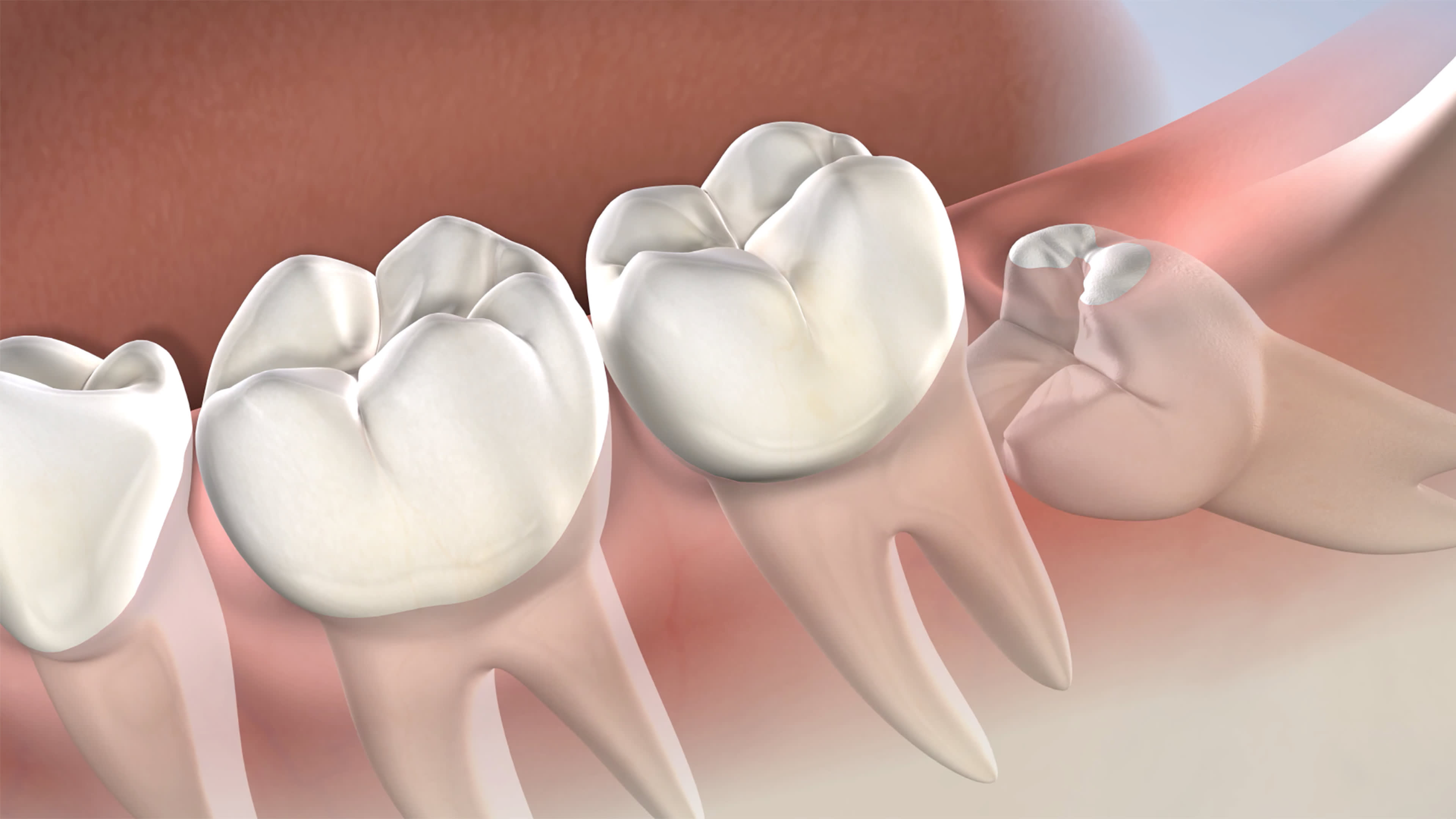 Before Your Wisdom Tooth Surgery: Key Preparation Tips