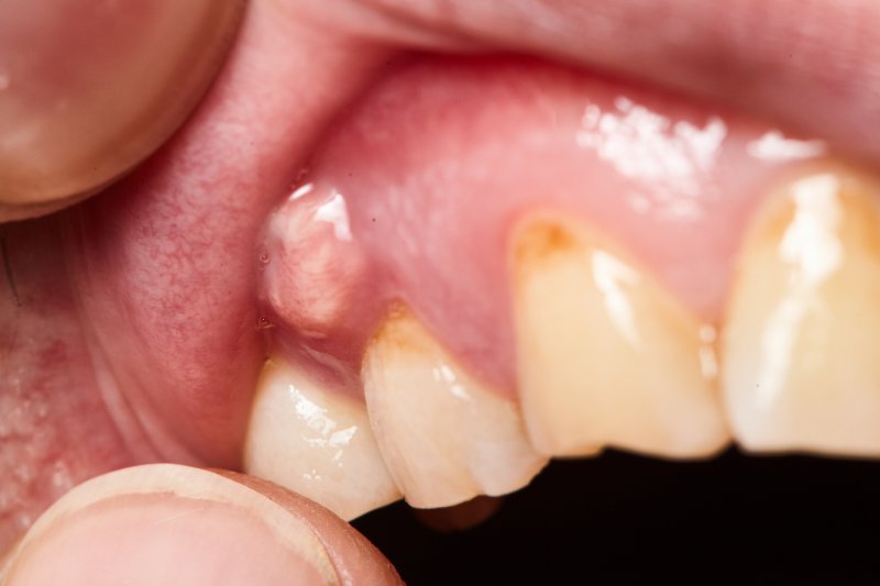 Saving Teeth, Saving Smiles: The Role of Root Canal Treatment.