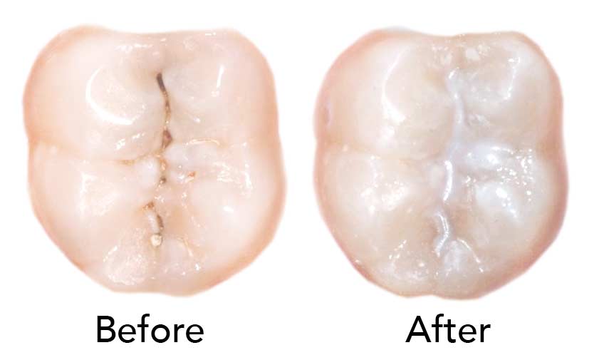Dental Sealants