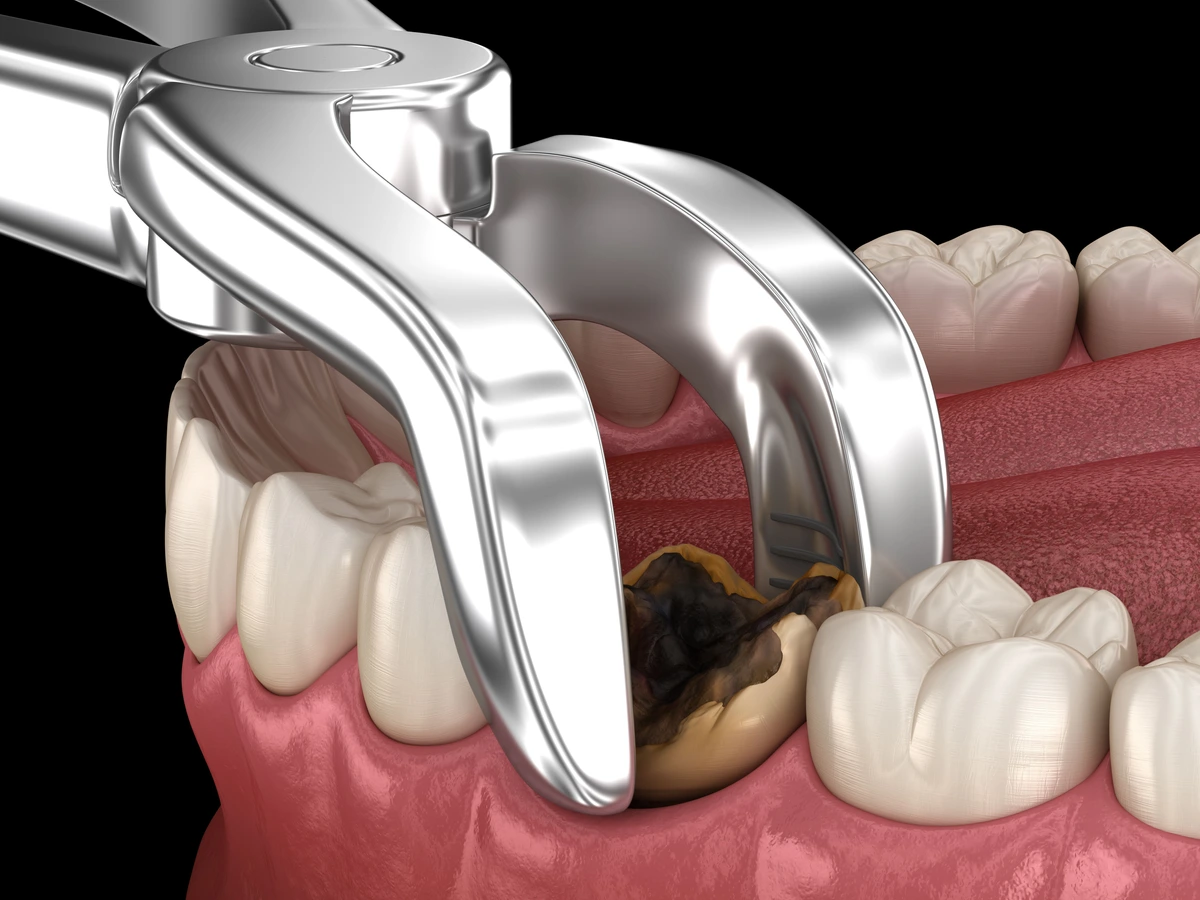 Understanding Dental Extractions: Procedure and Aftercare Options