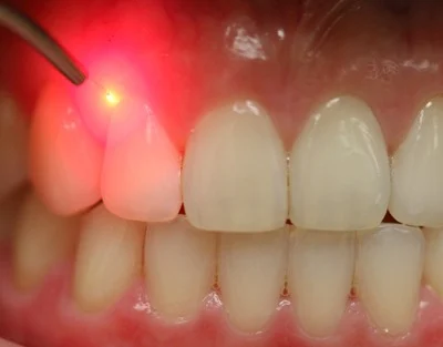 What is Laser Dentistry?