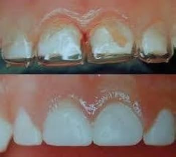 Strip Off Crowns