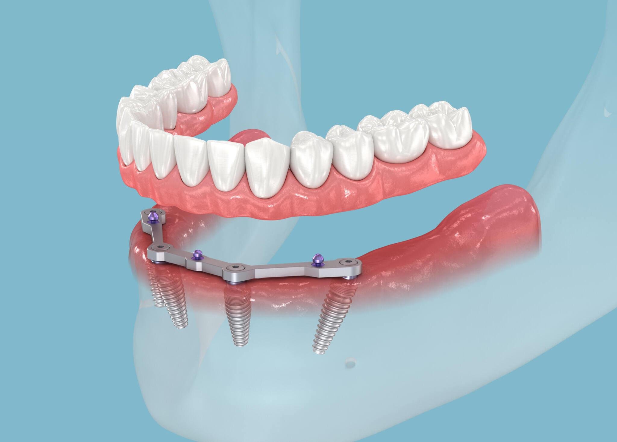 Why Choose All-On-4 Implant? 