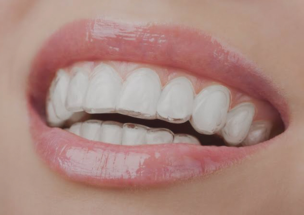 Upgrade Your Smile with Invisalign