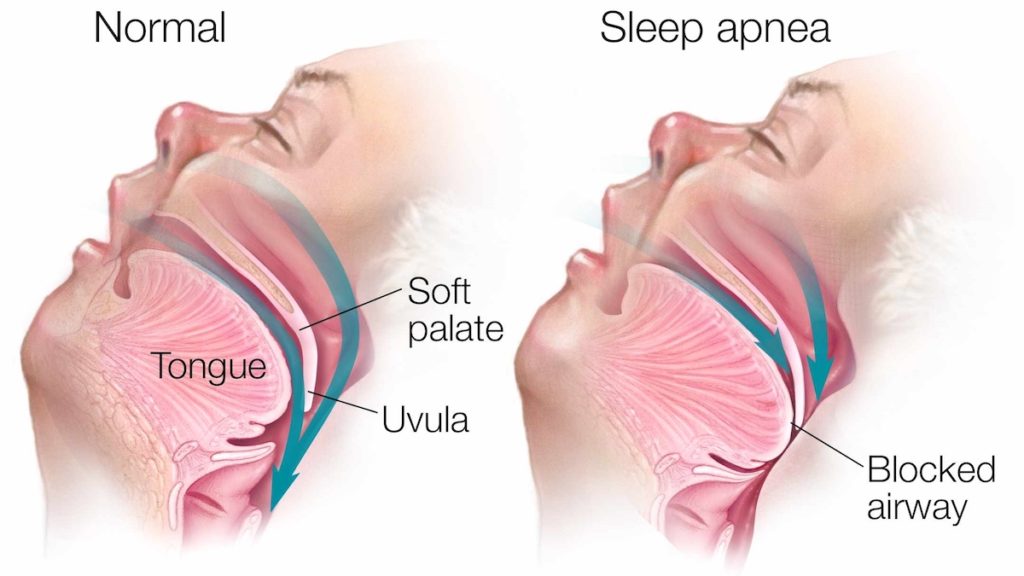 Know About Sleep Apnea