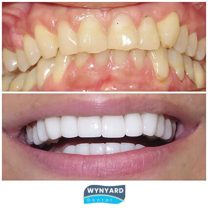 Say Hello to Your Best Smile with Veneers