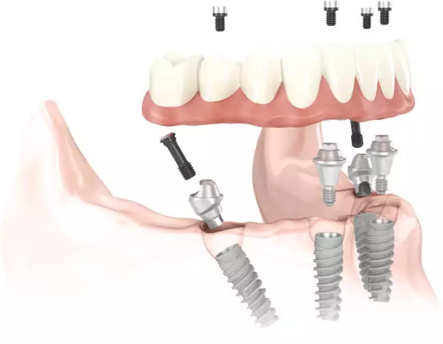 Full Mouth Dental Implants Process: Step-by-Step