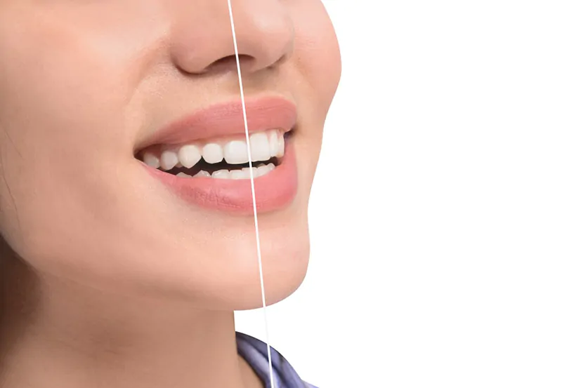 Benefits of Gum Contouring