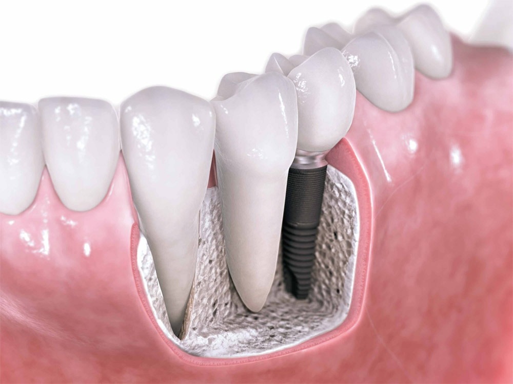 Implant Dentistry: Restoring Function and Aesthetics