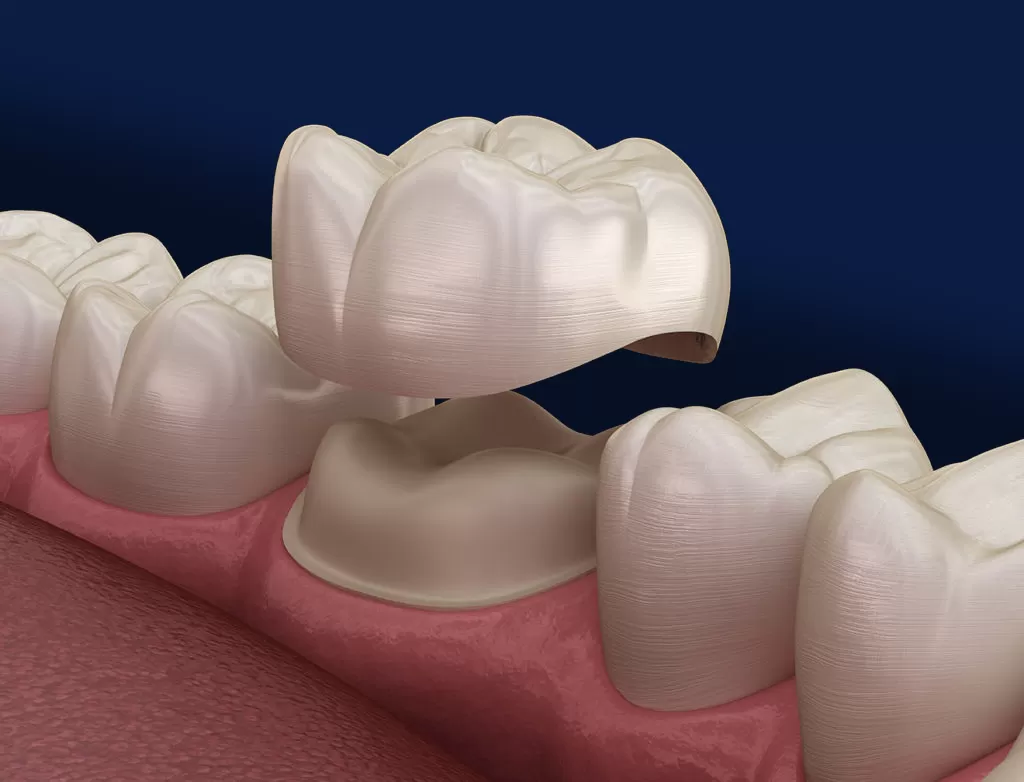 Restoring Your Smile with Dental Crowns