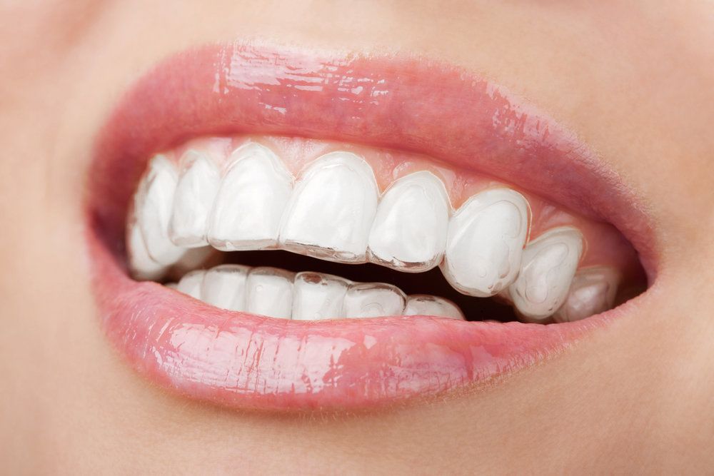 Why Invisalign is Revolutionizing Orthodontic Treatment
