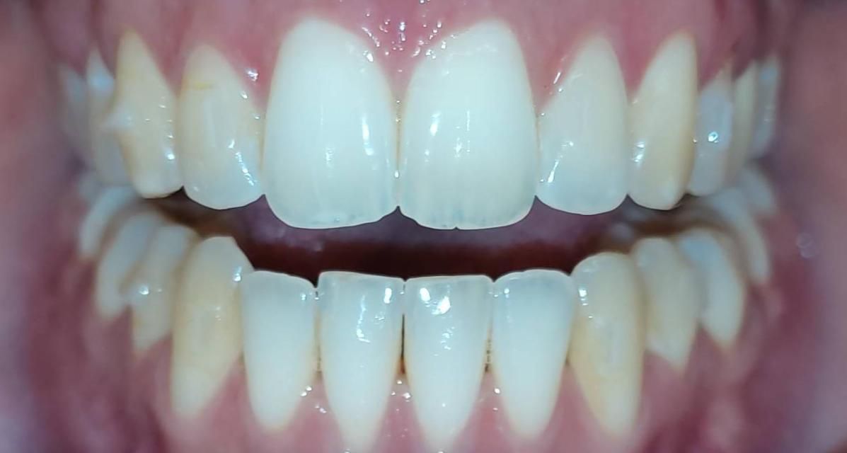 What is an Open Bite?