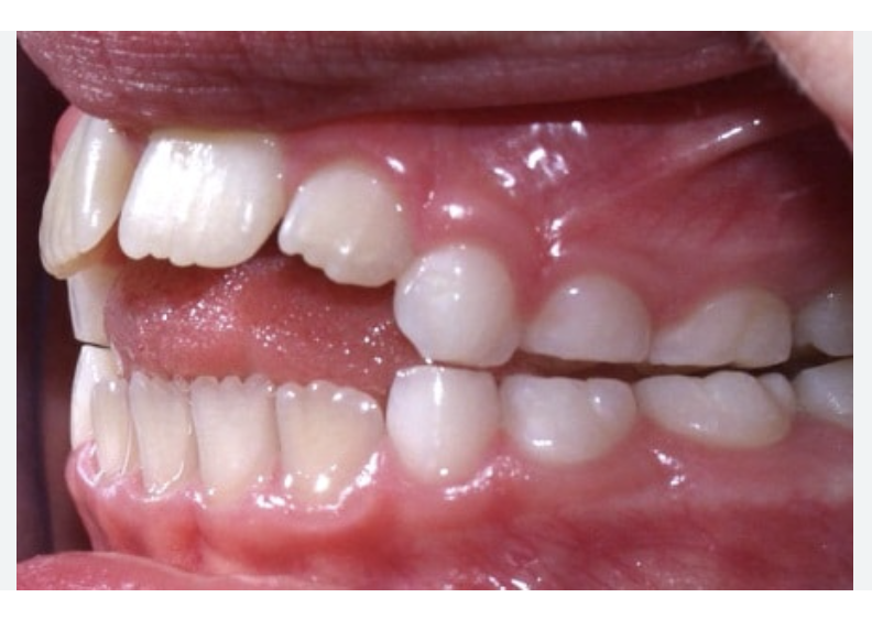 Thumb Sucking and Its Impact on Teeth