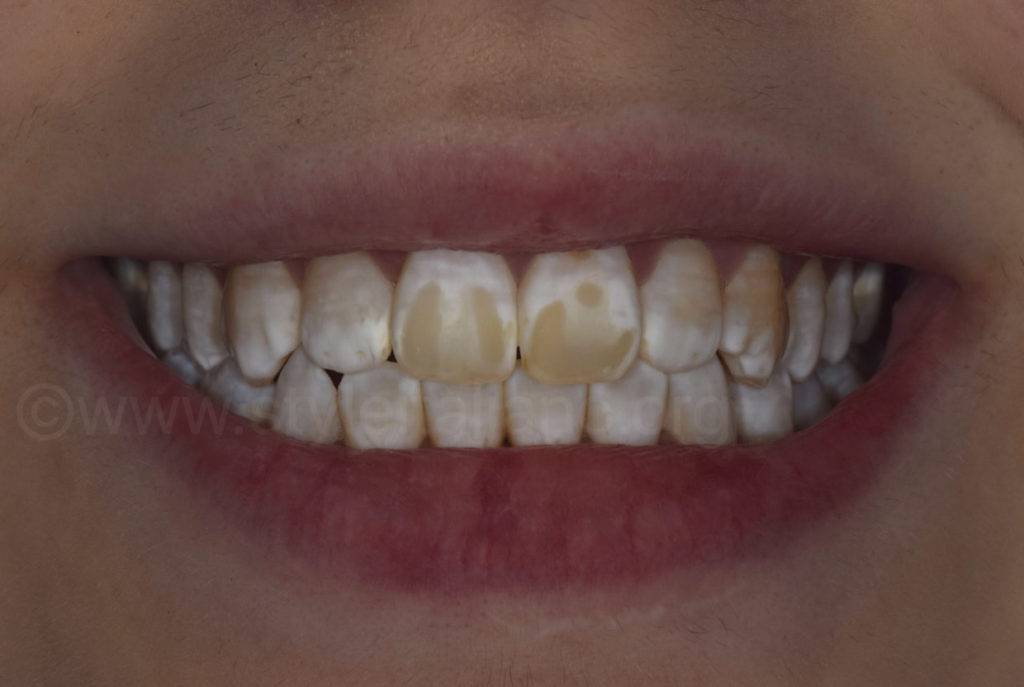 Understanding Dental Fluorosis: What It Is and How to Treat It