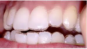 Invisalign: Your Smile, Your Way