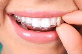 Benefits of Invisalign