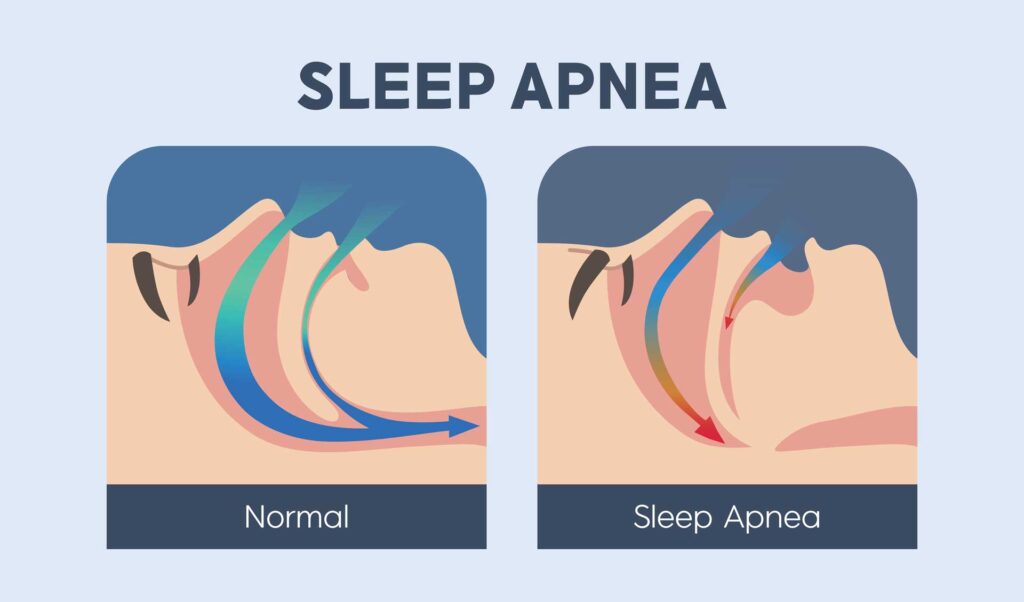 Obstructive Sleep Apnea (OSA) and Snoring
