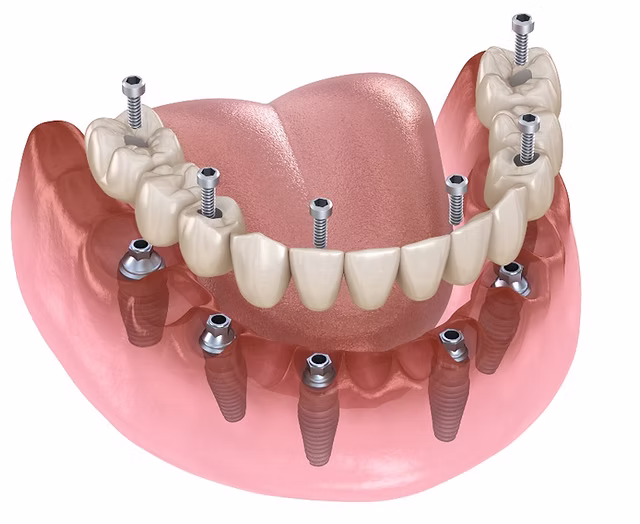 All-on-6 Dental Implants Recovery 