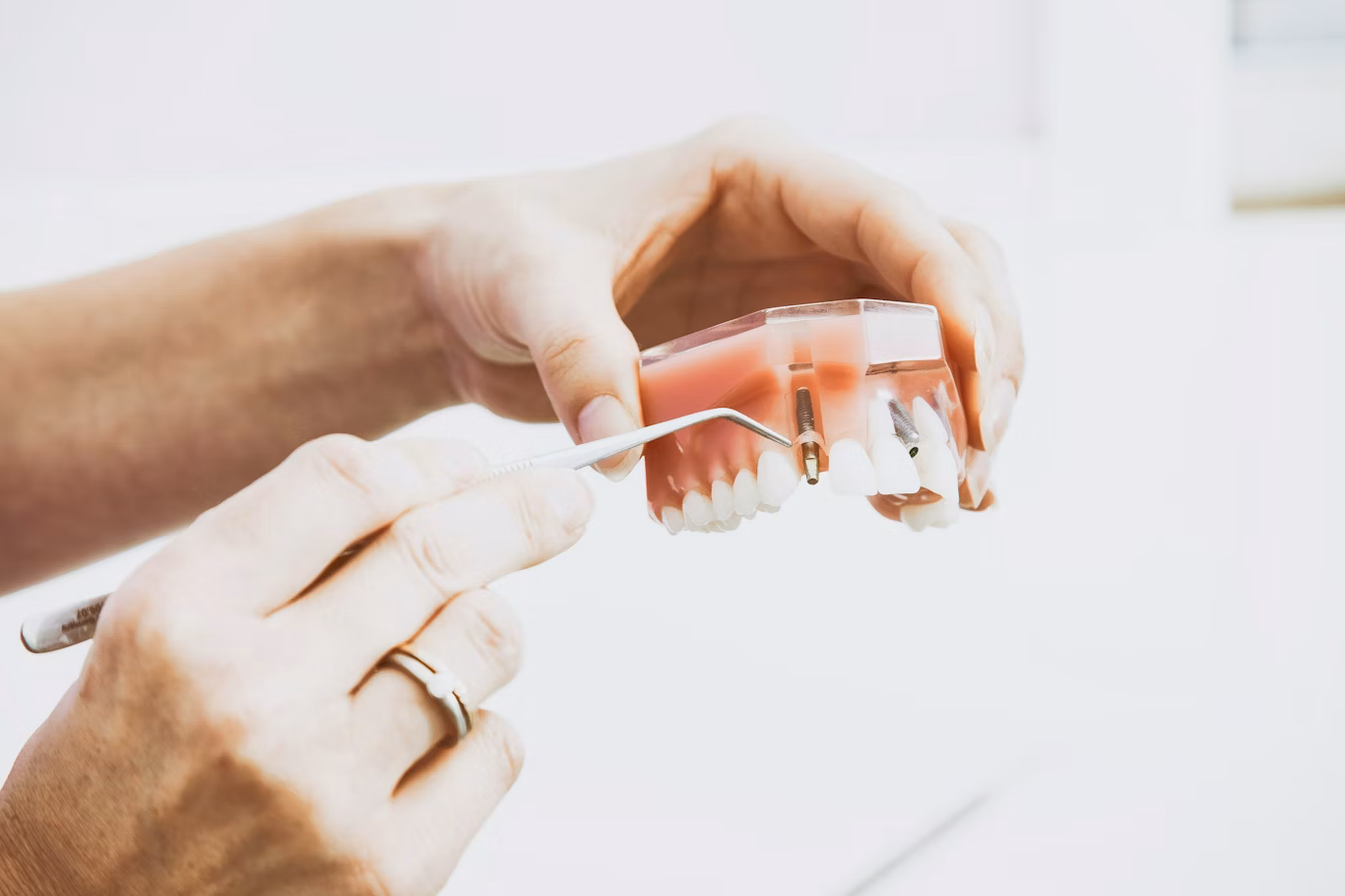 How Do Single Implants and All-On-4 Differ?