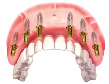 What is the All-on-6 Dental Implant Procedure?