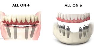 Dental Implant FAQs: What Patients Ask Most